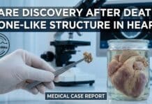 A Rare Discovery After Death: Doctors Find Bone-Like Structure Inside a Man’s Heart Doctors Find Bone-Like Structure Inside a Man’s Heart: A Rare Discovery After Death